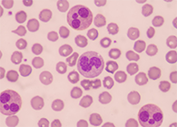 一种神秘颗粒被发现了！它能否成为败血症早筛标志物？